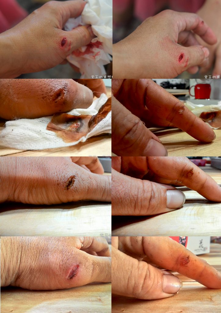 20150920手指受傷