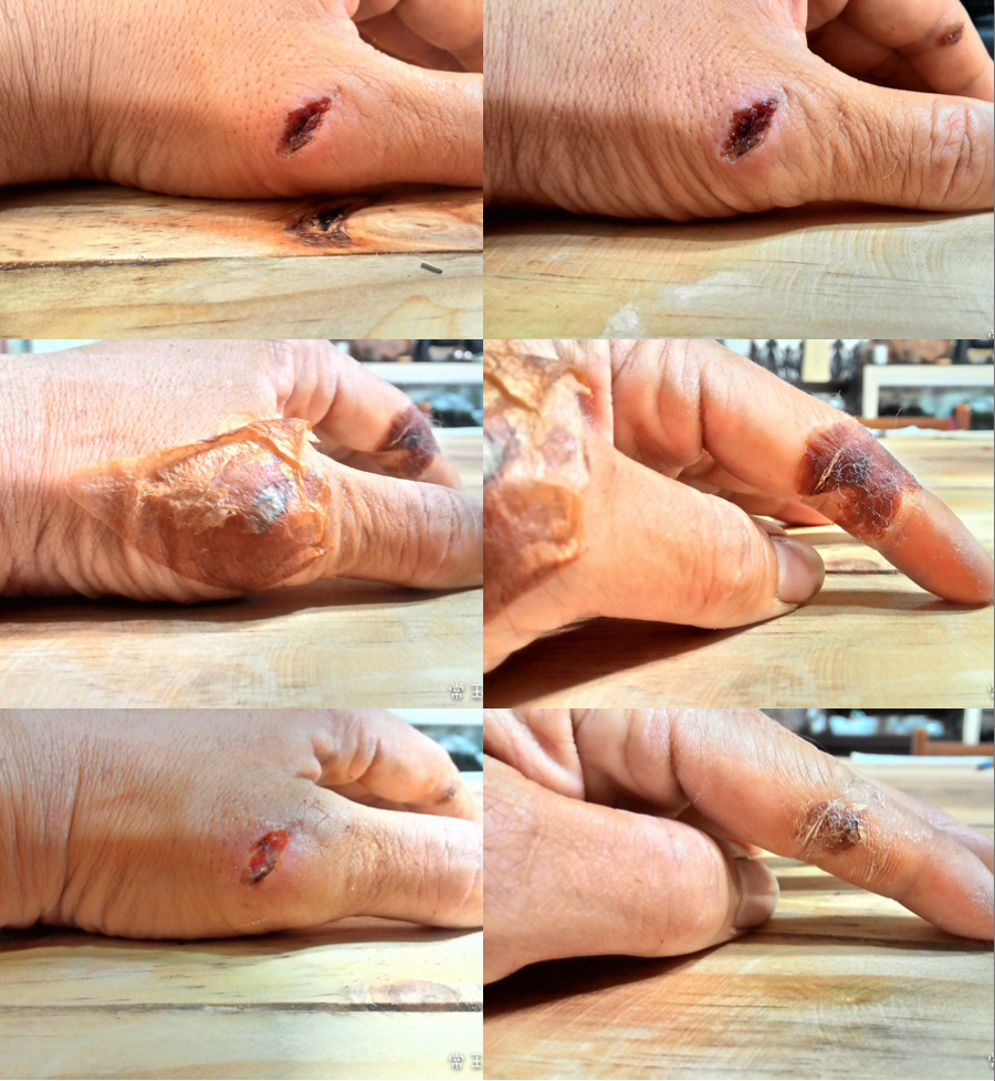 20150920手指受傷2